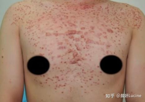 背部痘痘真菌性毛囊炎_背部痘痘酮康唑洗剂_痘痘留下黑色素沉淀