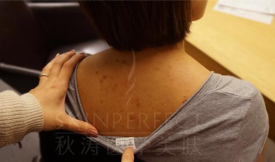 背部痘痘真菌性毛囊炎_背部痘痘酮康唑洗剂_痘痘留下黑色素沉淀