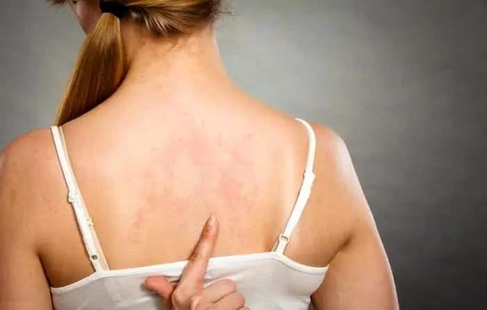 背部痘痘酮康唑洗剂_痘痘留下黑色素沉淀_背部痘痘真菌性毛囊炎