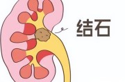 肾里结石咋长的？这三个习惯是祸根