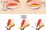 大连沙医生双眼皮修复价格 修复案例参考