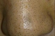 盐、牛奶、珍珠粉去黑头，能像饭团收缩毛孔吗？