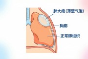 肺大泡是肺癌吗？别慌！出现这种症状要马上就医