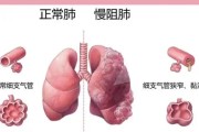 CT查出肺大泡形成？说明肺已受损，别忽视