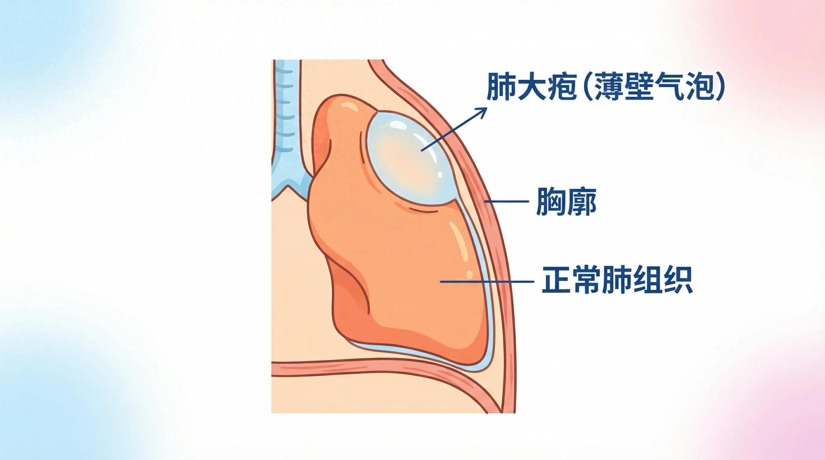 肺大泡形成_肺大疱怎么办_肺大疱破裂怎么办