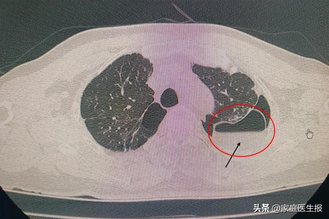 江西省胸科医院肺大泡治疗_肺大泡切除术_肺大泡形成
