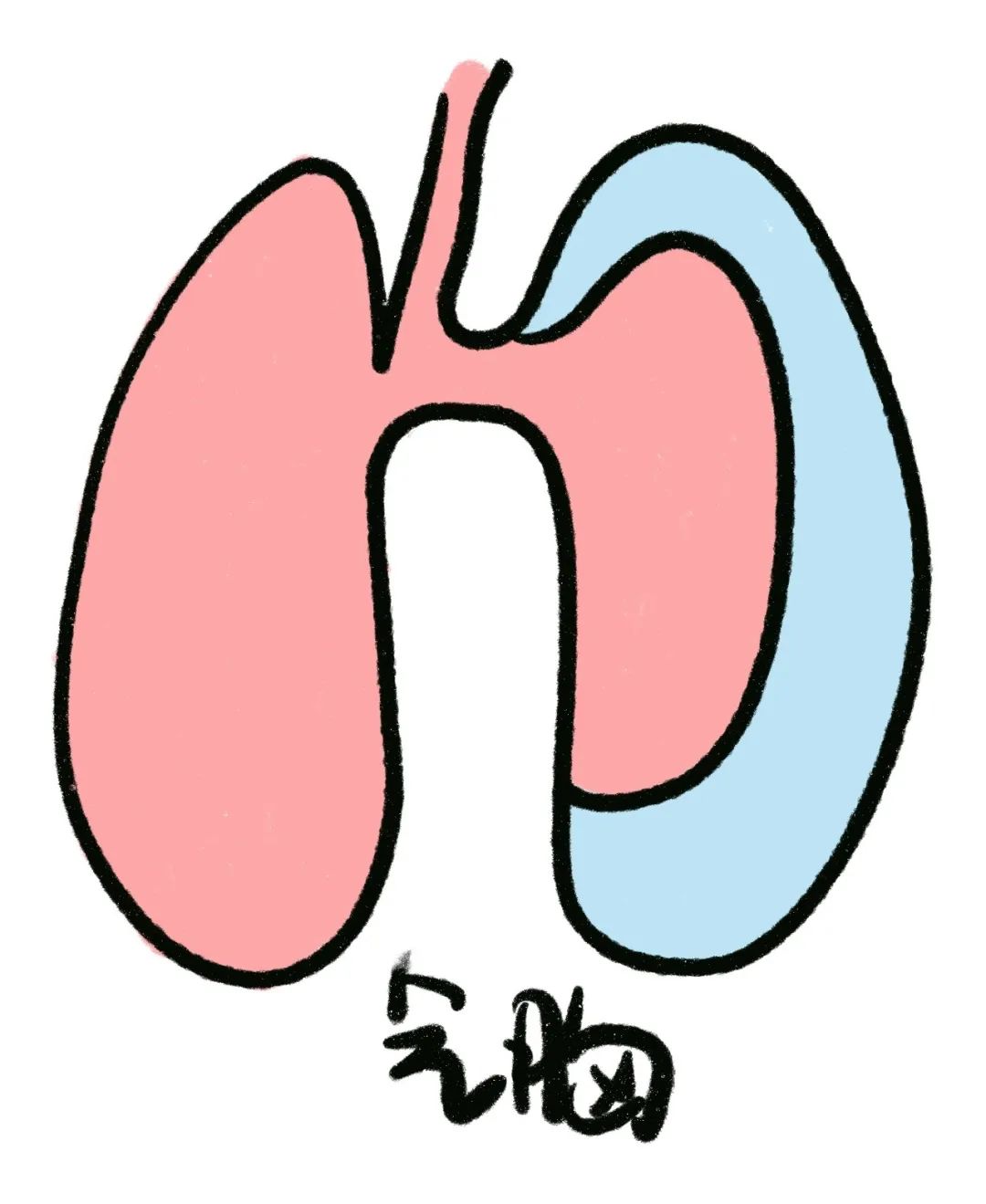 气胸症状_自发性气胸_肺大泡形成