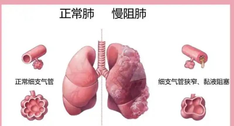 肺纹理紊乱肺野透亮度增加_肺气肿CT表现_肺大泡形成
