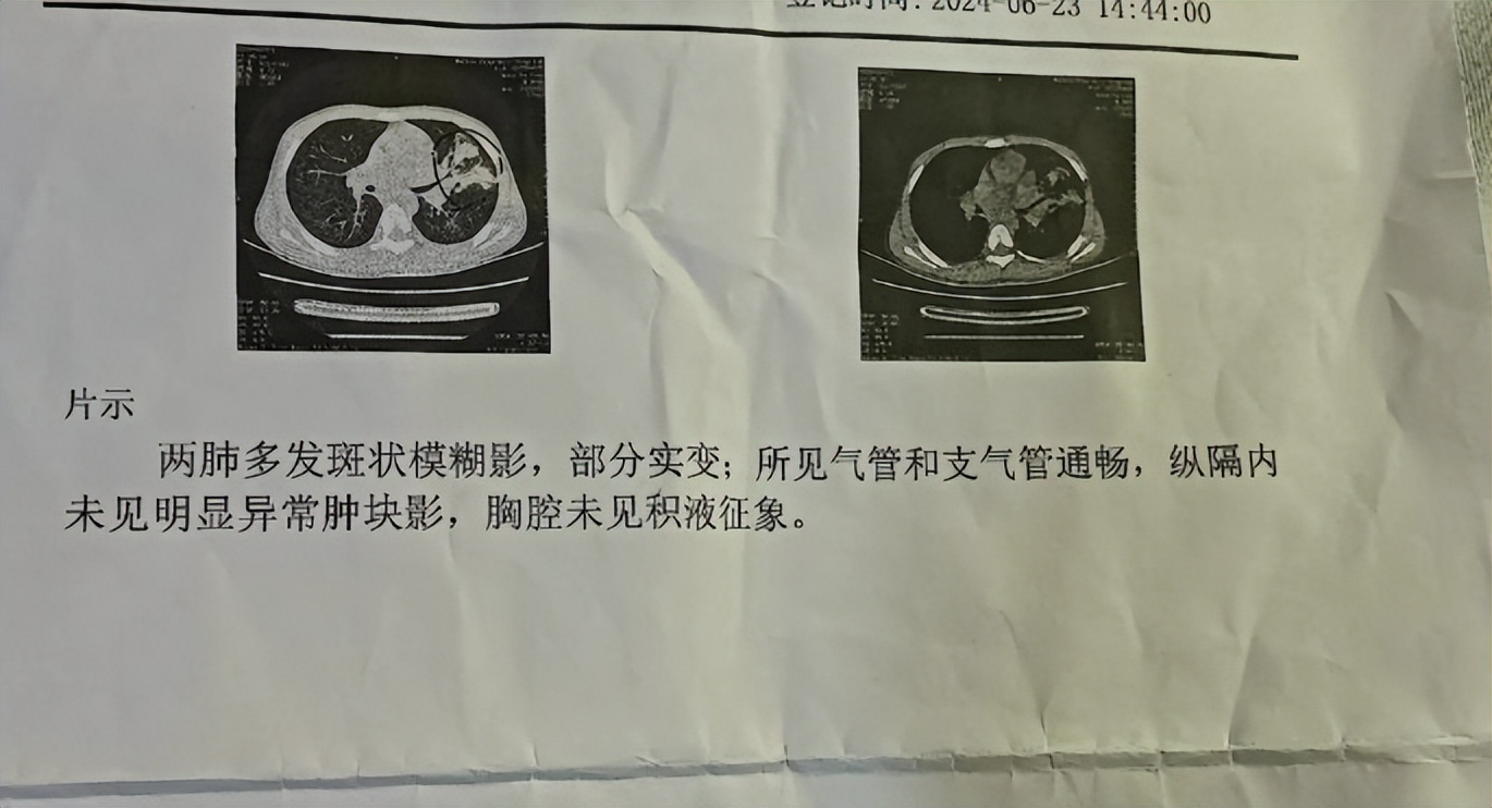 肺大泡形成_肺气肿CT表现_肺纹理紊乱肺野透亮度增加