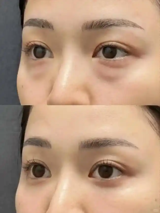 抗衰老眼霜排行榜10强_男士除眼袋的最好方法_男士眼霜去眼袋推荐