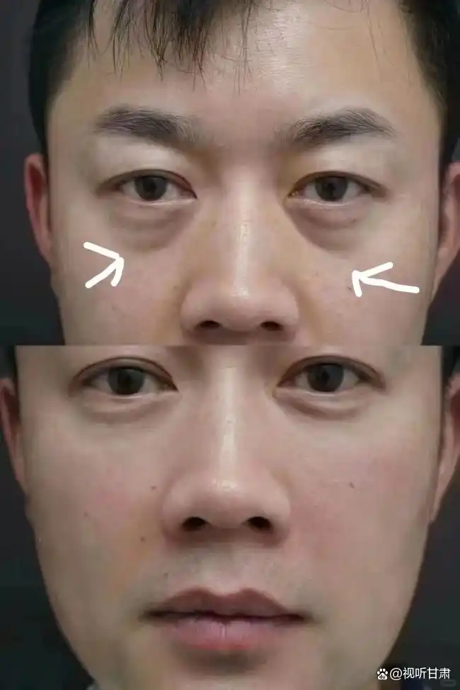 男士除眼袋的最好方法_什么眼霜去眼袋效果好_露卡菲娅小蓝瓶淡纹眼霜