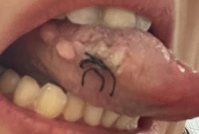舌头上长疙瘩是什么原因_孩子舌头起泡了疼怎么办才好_舌头上的疙瘩怎么办