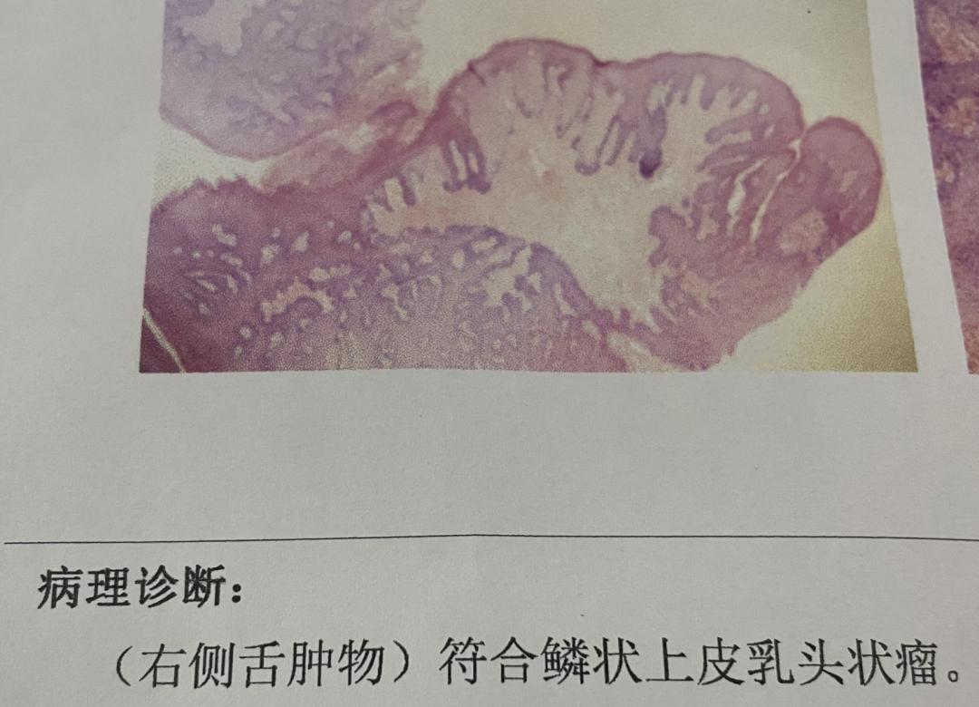 舌头上的疙瘩怎么办_舌头上长疙瘩是什么原因_孩子舌头起泡了疼怎么办才好
