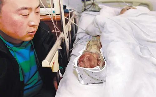 咬伤后感染症状_被人咬伤后处理方法_让狗咬了出血了怎么办