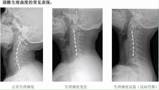 挑选枕头预防颈椎病_颈椎病适合什么枕头_枕头高度与颈椎生理曲度