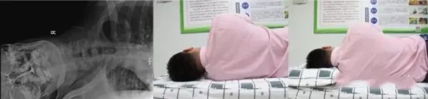 颈椎病适合什么枕头_选对枕头方法_枕头高度选择