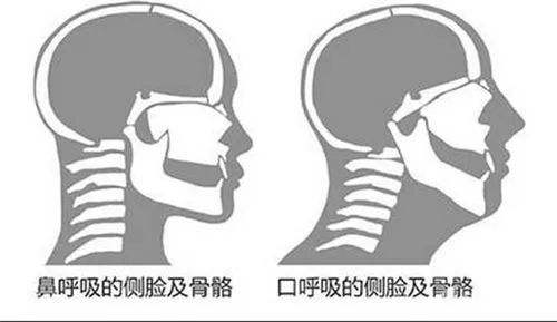 鼻子不通气睡觉怎么办_晚上睡觉总用嘴巴呼吸原因_用嘴巴呼吸有什么危害