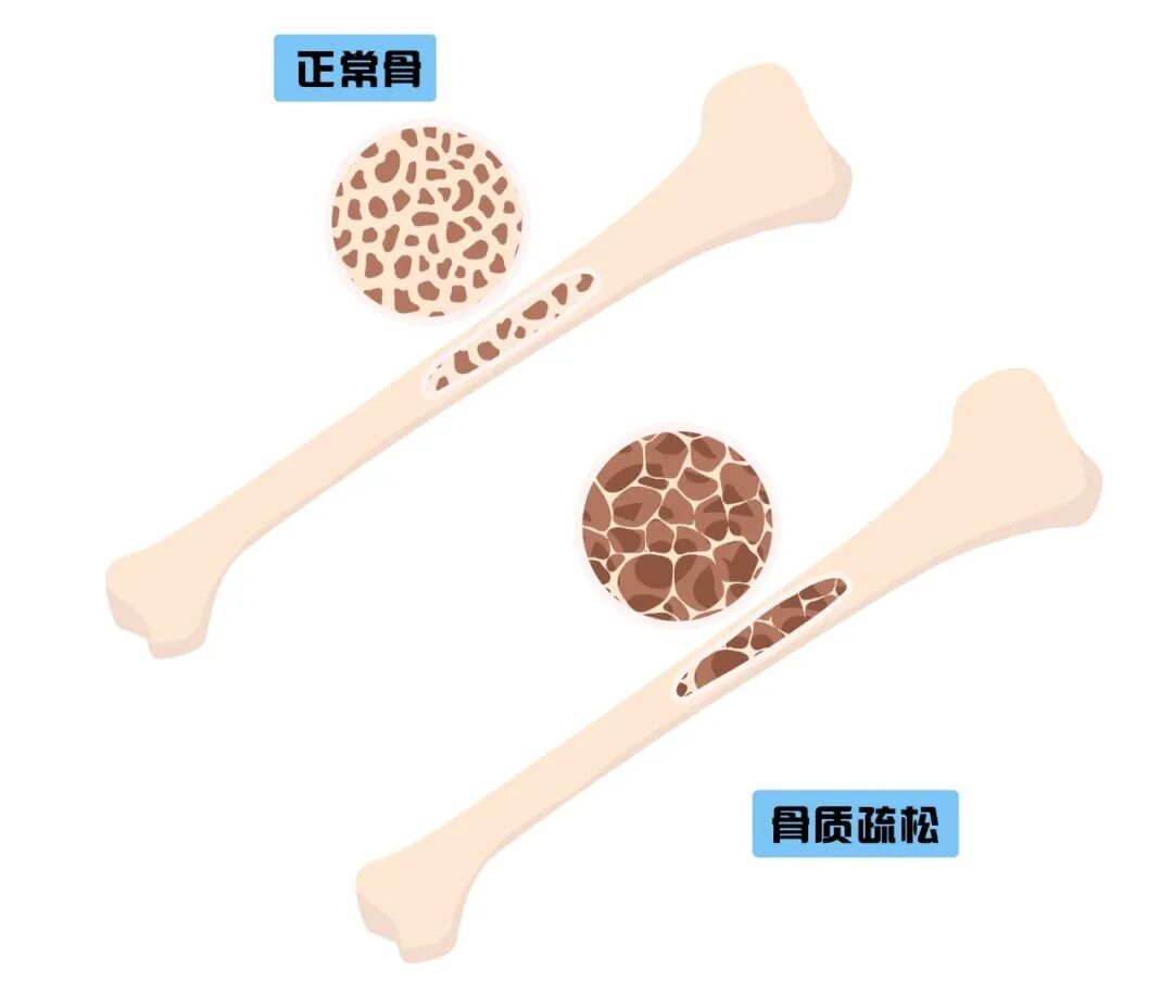 骨质疏松的相关知识_骨质疏松预防方法_骨质疏松早期信号