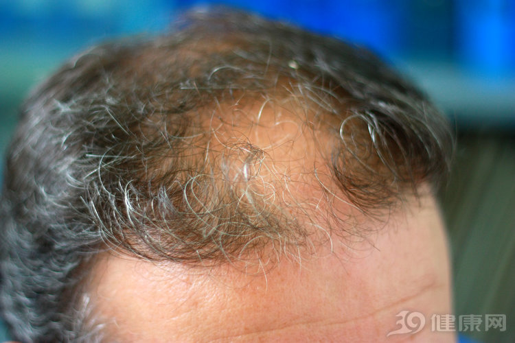 染发致癌风险_买染发剂需要注意什么_频繁染发危害