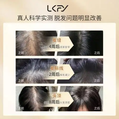 cosplay防脱发攻略_露卡菲娅防脱精华液_防脱发最好的产品