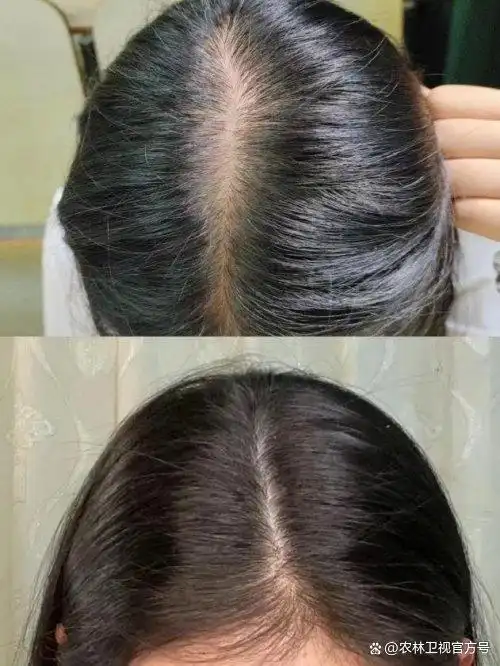 防脱生发产品口碑排行_防脱发最好的产品_世界十大防脱育发品牌排行榜