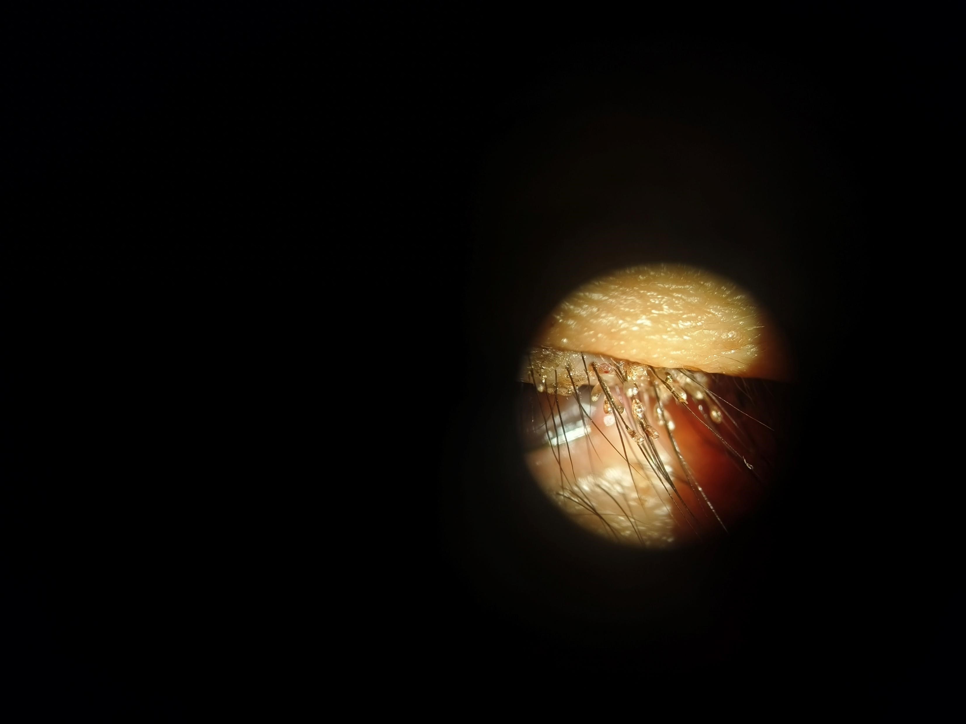 小孩有头虱子怎么去除_长沙市中心医院眼科阴虱治疗_阴虱寄生睫毛症状