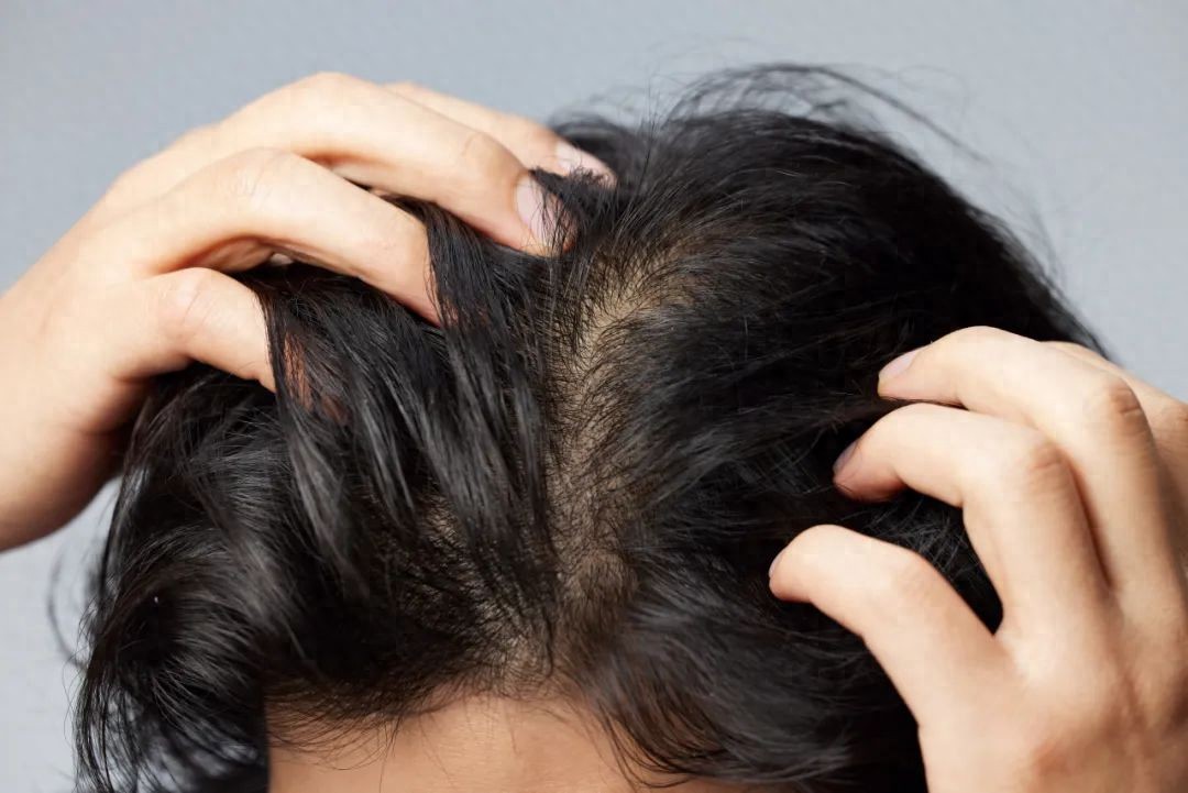 肾虚会影响植发效果吗_雄激素性脱发植发_女性型脱发植发