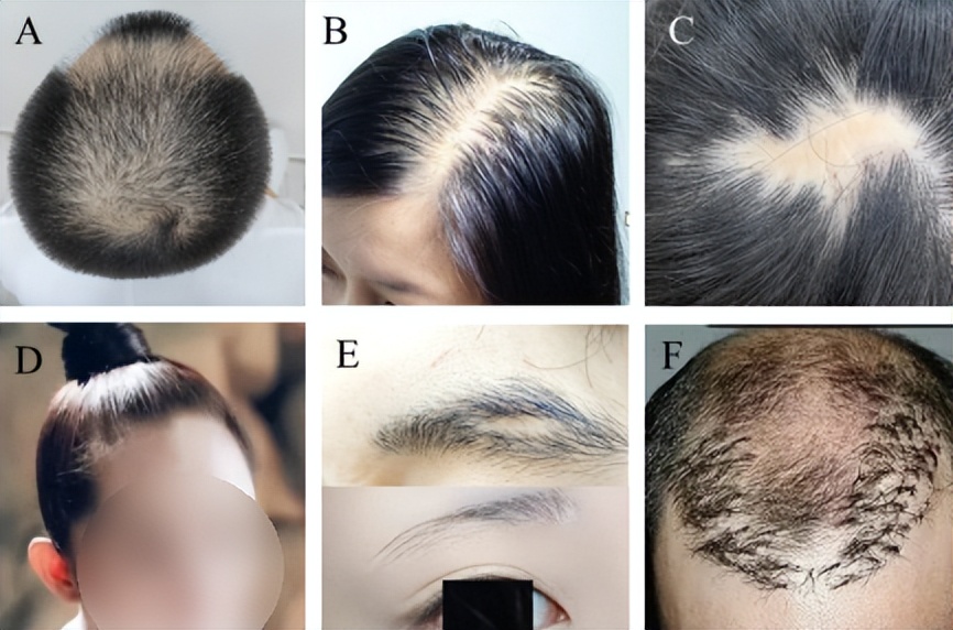 女性型脱发植发_雄激素性脱发植发_肾虚会影响植发效果吗