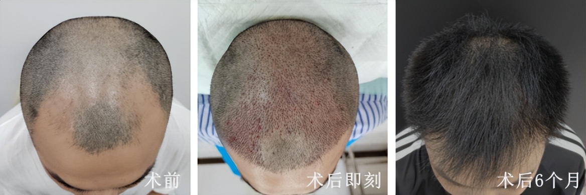 肾虚会影响植发效果吗_女性型脱发植发_雄激素性脱发植发