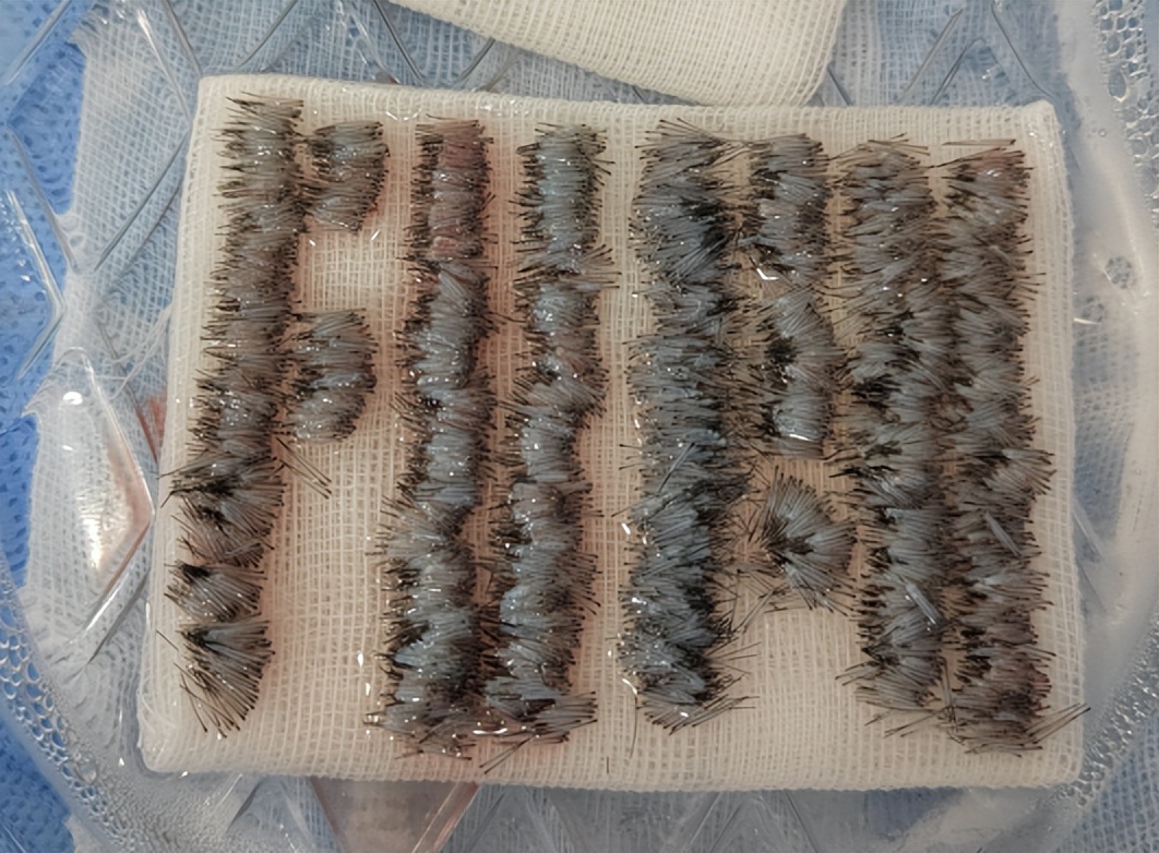 肾虚会影响植发效果吗_雄激素性脱发植发_女性型脱发植发