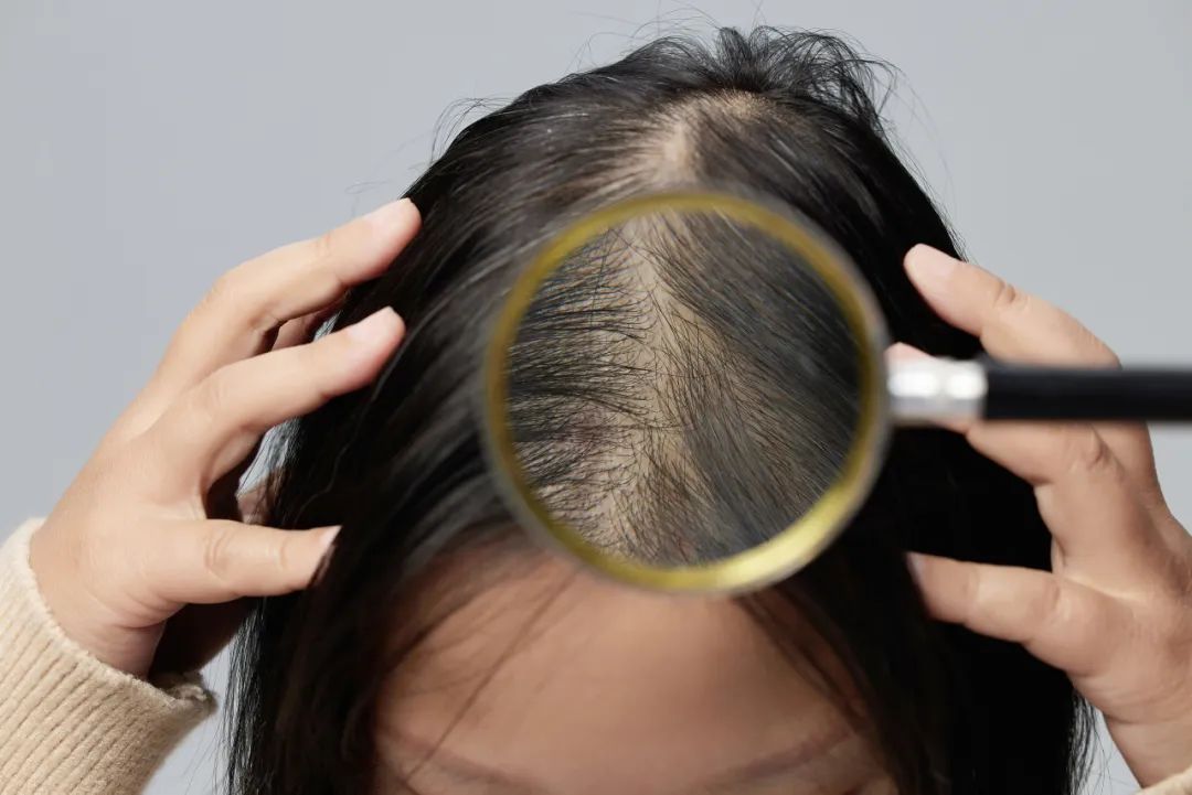 雄激素性脱发植发_女性型脱发植发_肾虚会影响植发效果吗