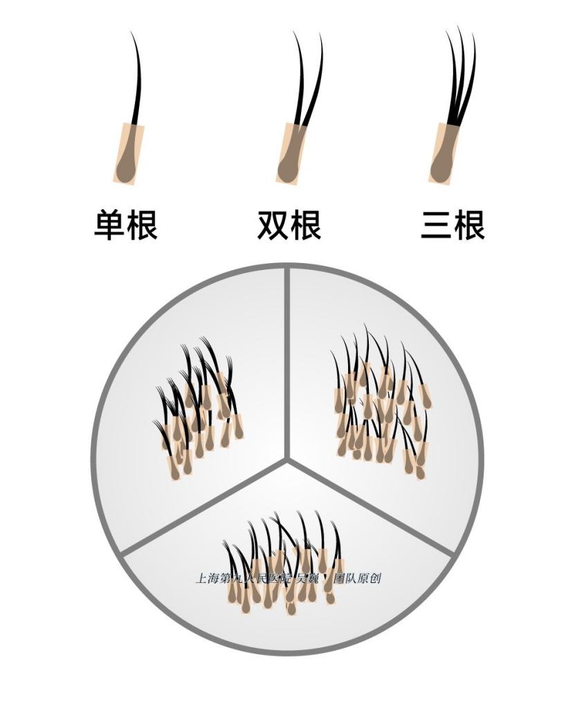 植发后多久长头发_植发手术步骤_肾虚会影响植发效果吗