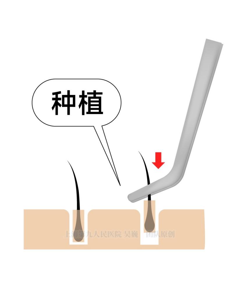 植发后多久长头发_植发手术步骤_肾虚会影响植发效果吗