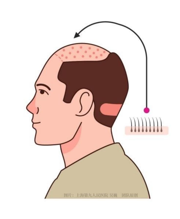 植发后多久长头发_肾虚会影响植发效果吗_植发手术步骤