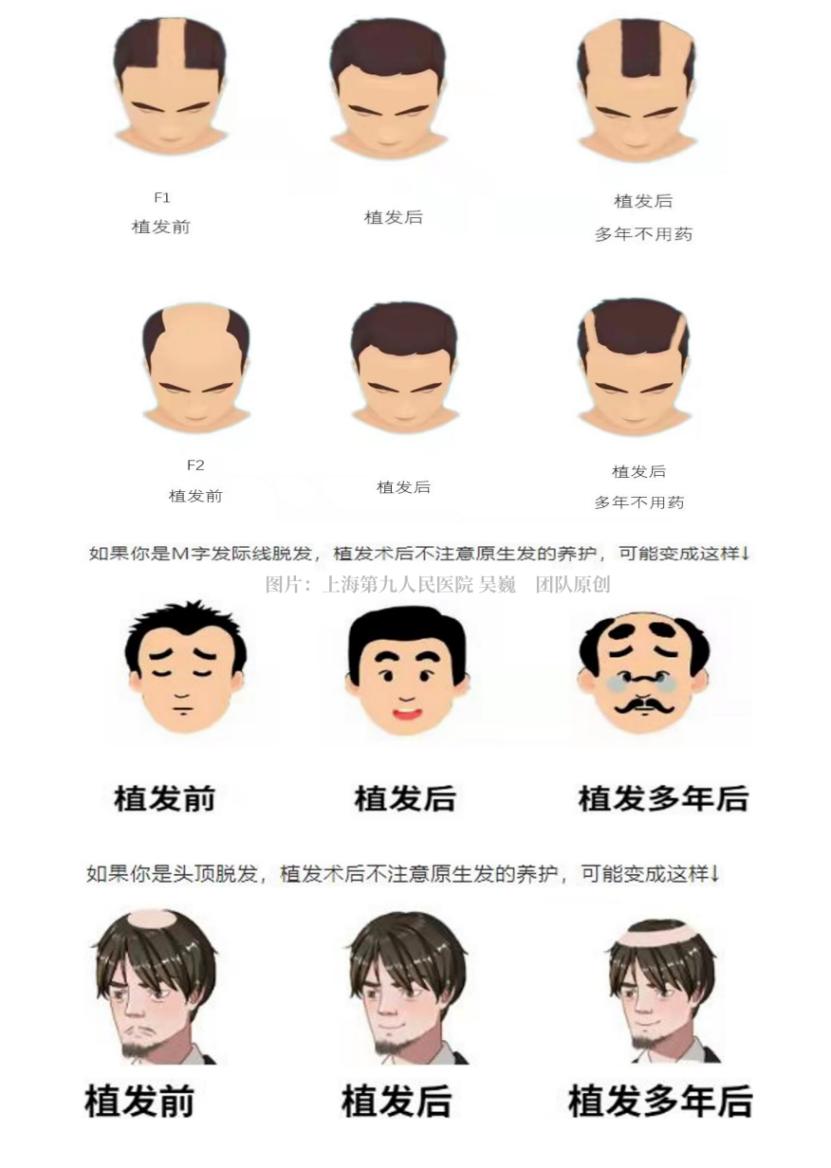 植发后多久长头发_肾虚会影响植发效果吗_植发手术步骤