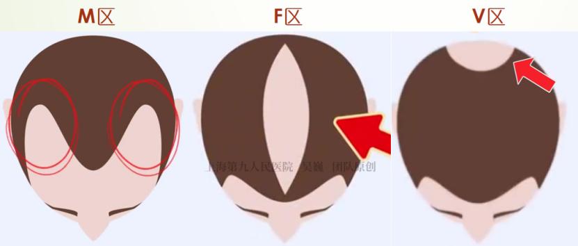 肾虚会影响植发效果吗_植发手术步骤_植发后多久长头发