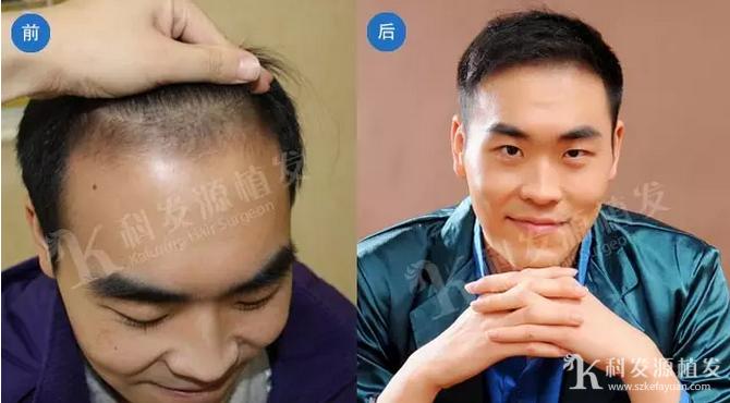 春季植发_肾虚会影响植发效果吗_植发最佳季节