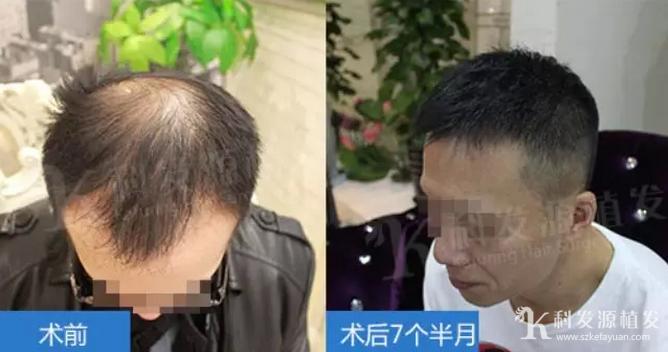 春季植发_植发最佳季节_肾虚会影响植发效果吗