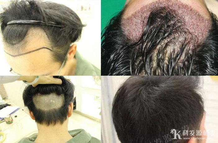 肾虚会影响植发效果吗_植发最佳季节_春季植发