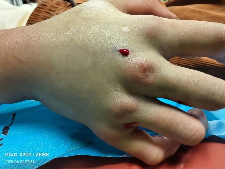 云南有没有眼镜蛇血清_重庆五步蛇咬伤急救_重庆常见毒蛇种类及防治