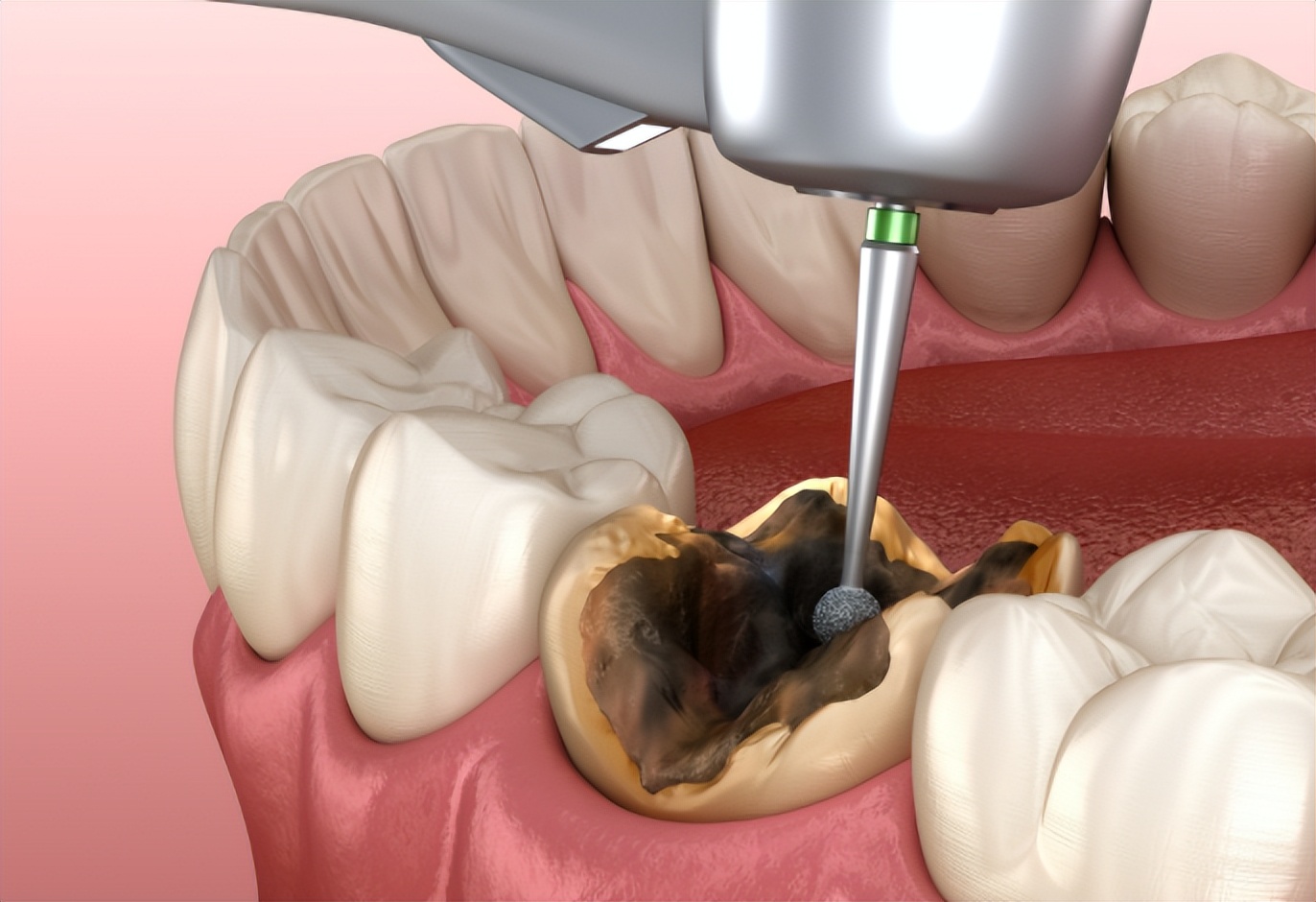 牙齿变色神经死了没有_牙齿松动牙龈出血癌症信号_牙龈溃疡不愈癌症征兆