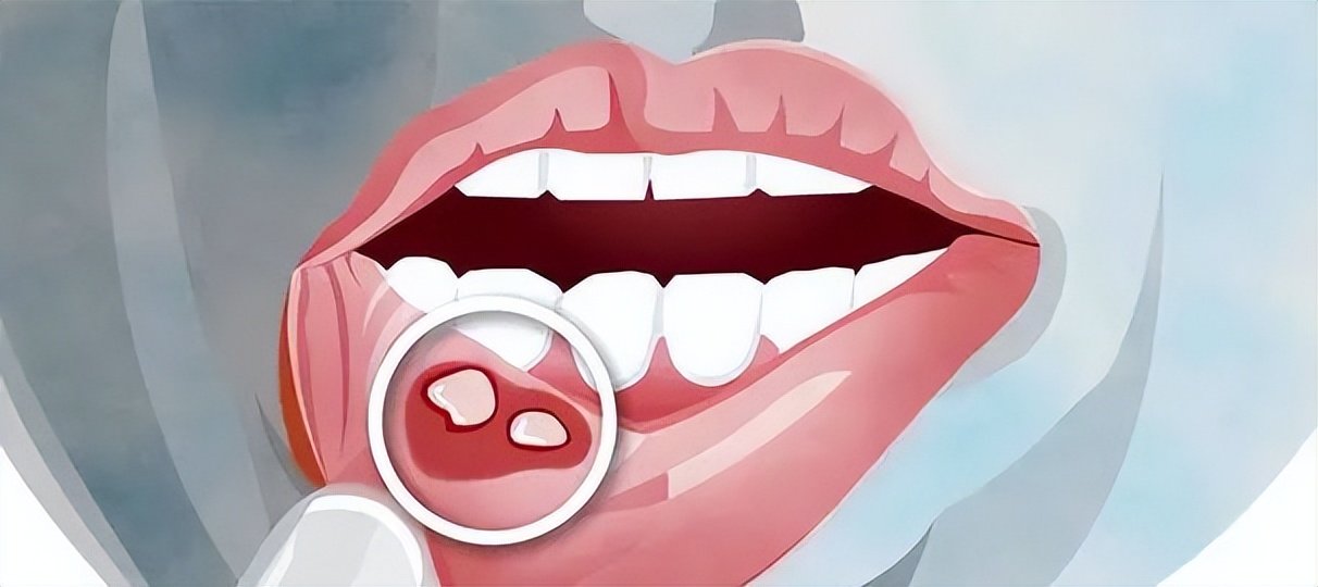 牙齿变色神经死了没有_牙龈溃疡不愈癌症征兆_牙齿松动牙龈出血癌症信号