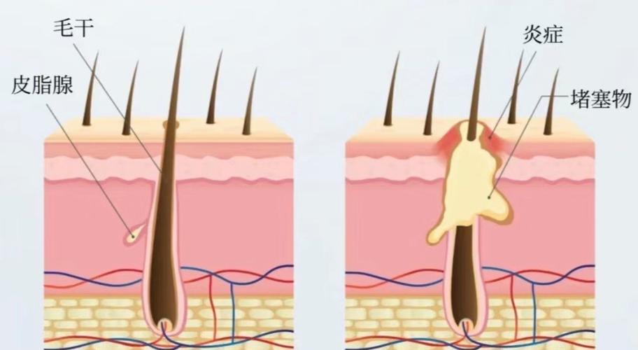 雄激素性脱发饮食调理_头发软稀少怎么办食补可以么_雄激素性脱发