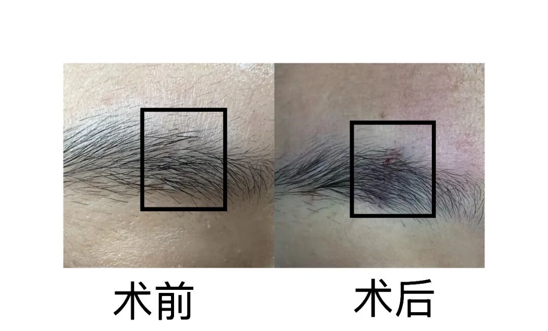 三甲医院有种植头发的吗_沈阳市第七人民医院毛发诊疗中心_瘢痕性脱发