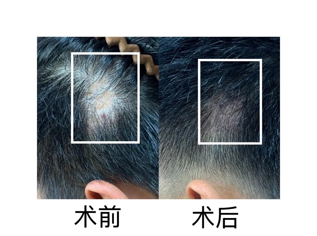 沈阳市第七人民医院毛发诊疗中心_瘢痕性脱发_三甲医院有种植头发的吗