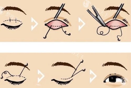 双眼皮操作示意图