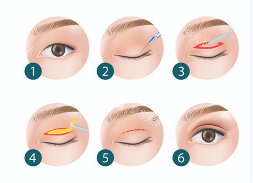 双眼皮手术过程图