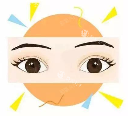 全切双眼皮效果图