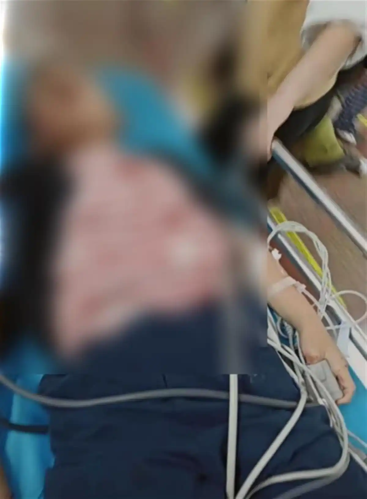 攀枝花实验幼儿园筷子插鼻事件_小孩玩筷子扎伤上口腔_幼儿园鼻穿孔赔偿纠纷