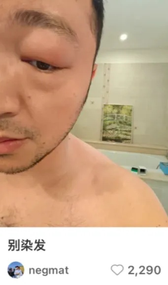 尼格买提染发过敏原因_用染发剂改皮鞋颜色吗_染发过敏症状